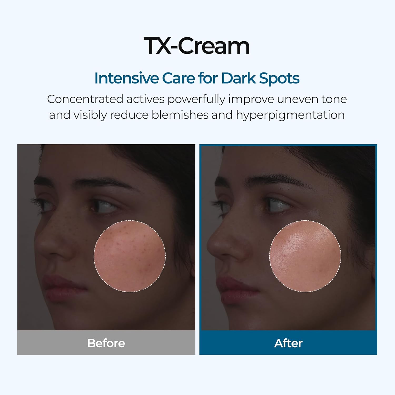 Cream for the removal of dark spots